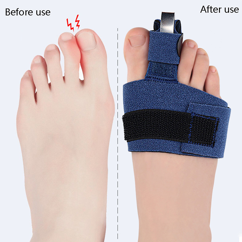 1 قطعة مصحح إصبع القدم، مثبت ل - مراجعة Ankle Brace Sock وسعره